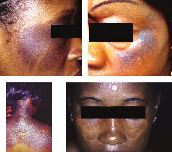 5 Side-Effects of Skin Bleaching Creams