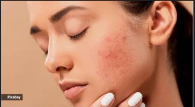 How to Treat Pimples and Acne Scars with Saliva