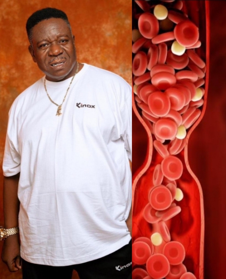 Blood Clotting: What to Know About the Ailment Mr Ibu Suffered Before He Died