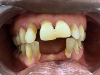 What Plaque Does To your Teeth