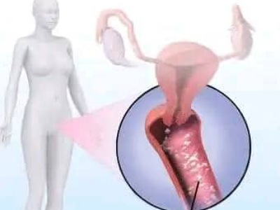 Vaginal Yeast Infections: Symptoms, Causes, and Treatments